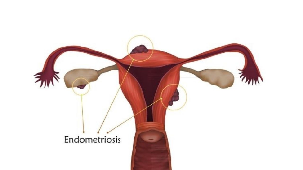 gynecology-endometriosis