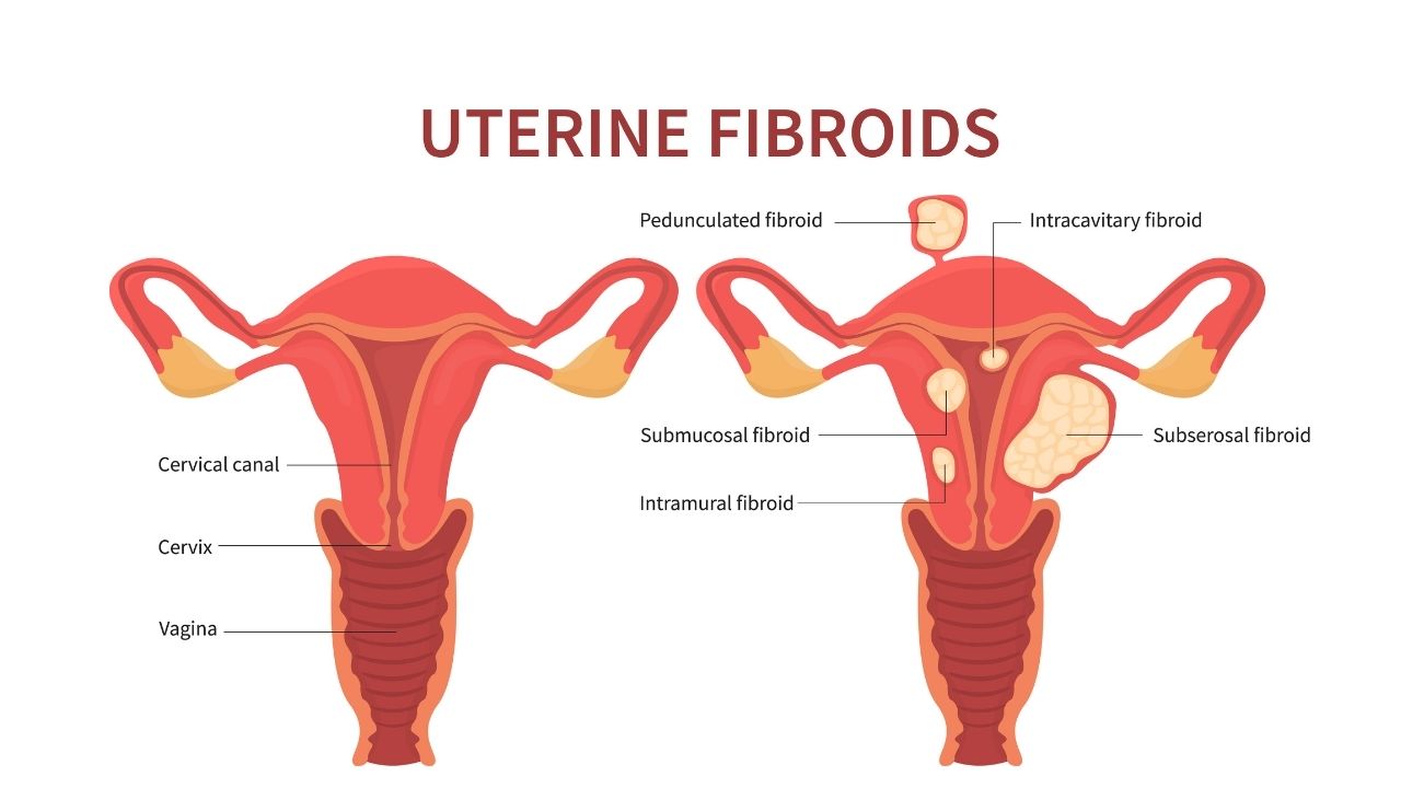 gynecology-uterine-fibroid