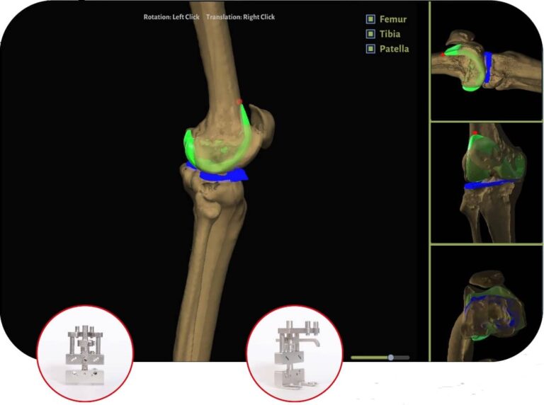 total-knee-joint-replacement