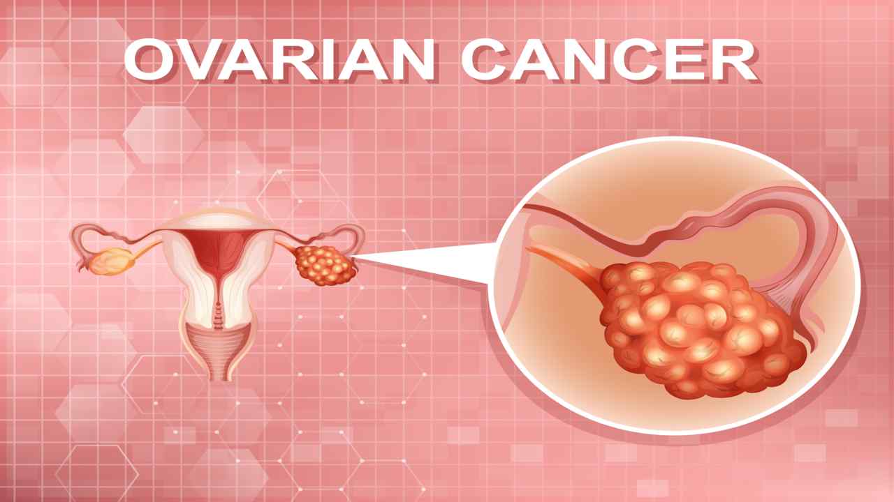 gynecological-ovarian-cancer
