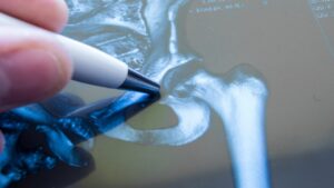 Hip fractured