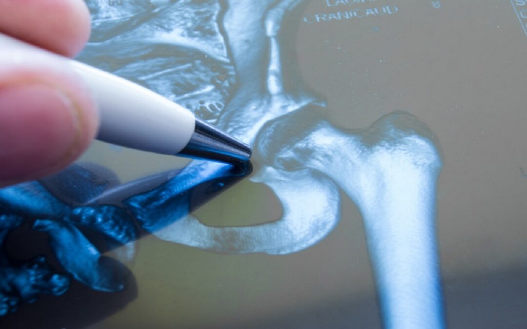 Why Do Hip Fractures Necessitate Immediate Treatment?